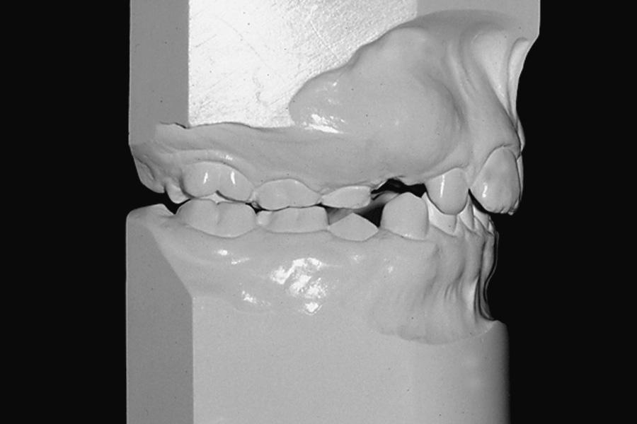In order to avoid any future restorations and prevent any negative facial changes, a chin cup and elastics were used to protract the maxillary and mandibular molars into a class I relationship (D).