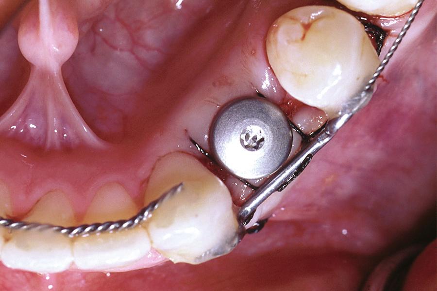 (Figure 2F) for the placement of a single-tooth implant (Figure 2G). This implant was restored with a second premolar crown (Figure 2H), which helped to re-establish proper occlusion for the patient.