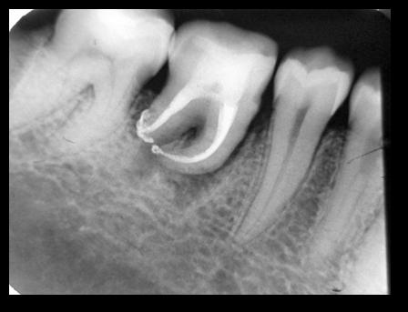 Figure1C. After endodontic treatment. At the 24 months follow-up, vertical bone growth was observed on the transplant distal and mesial area on radiographic examination (Figure 1D).