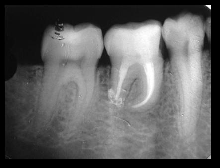 DISCUSSION Transplantation of a natural tooth into the site of another tooth has significant advantages over dental implants, particularly for periodontal ligament (PDL) and alveolar bone development