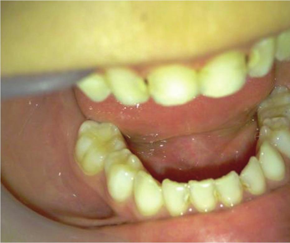 Case Reports in Dentistry 3 Figure 5: Restored tooth with resin composite. (a) (b) Figure 6: (a) Ten-month periapical view. (b) Ten-month panoramic view.
