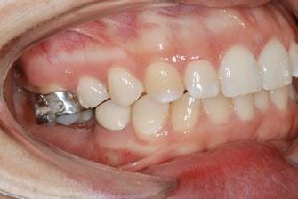 Case 1 A 25-year-old female was referred by her general dentist for intrusion of an overerupted upper right