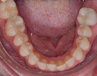 second molar site.