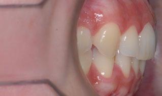 but there was inadequate space for placement of a molar crown (Fig. 6).