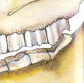 Common Equine Dental Malocclusions Molars CAUDAL HOOKS Definition - Dominant lower or upper last molar overhanging opposing molar.