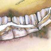 PERIODONTAL POCKETS Definition - Gum disease around tooth causing an area for feed to pocket. Etiology - Results from malocclusion or misalignment of teeth.