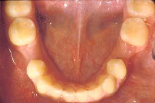 of adjacent teeth midline deflection in unilateral cases Becker A et al AJO 1992 102