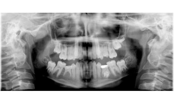 Missing Second Premolars- Associated Anomalies Infraocclusion 25% vs 9% Distoangular premolar 8% vs 0.2% Garib et al Angle Orthod 2009 : 79 : 436-41 Should we save or extract the E?