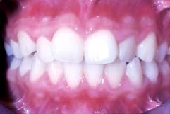 molars + build up