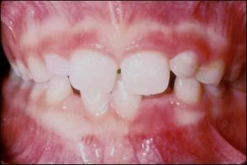 primary molars /