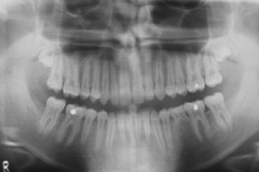 What is the survival rate of deciduous second molar with absent premolar?