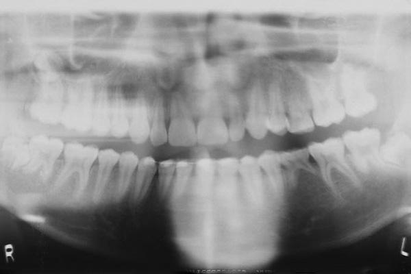 If deciduous molar lasts to adulthood without resorption or infraocclusion : excellent prognosis for