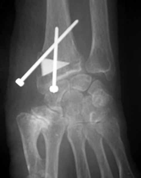 TREATMENT OF DISTAL RADIAL FRACTURES 37 Fig. 1. Intra-operative AP and lateral radiographs of the wrist radial aspect of the wrist, centered dorsally over the fracture site.