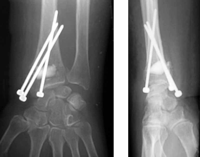 38 N. WILLCOX, I. KURTA, D. MENEZ Fig. 2. AP and lateral radiographs of the wrist on day 1 after internal fixation France) before being buried.