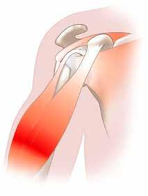 The shoulder is made up of three bones: the scapula (shoulder blade), the humerus (upper arm bone) and the clavicle (collarbone).