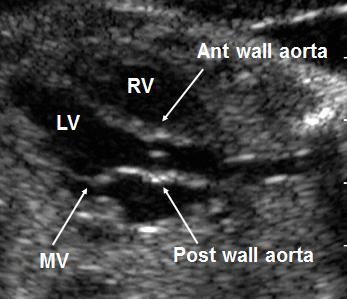 jpg Head Vessels Arising from Aortic Arch Long Axis View of Aorta Innominate