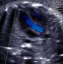 flow patterns Plays an important role in diagnosing congenital heart defects Optimal color Doppler settings