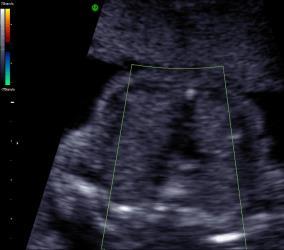 Ultrasound Obstet Gynecol 2013; 41:348-359 Color Flow Doppler Color Flow Doppler Diastole (atrioventricular