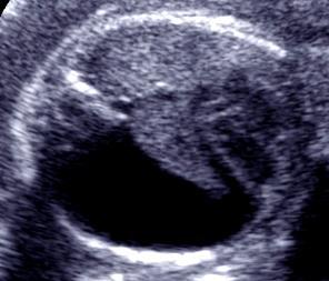 Obstet Gynecol 1987; 70:255-259 Normal Cardiac Axis and Position Cardiac Malposition Abnormal cardiac axis Left Right Often associated with intrinsic complex cardiac defects and dysrhythmias Abnormal