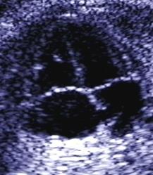 Atrial Septum Foramen Ovale Atrial septum Umbilical venous blood entering the inferior vena cava preferentially
