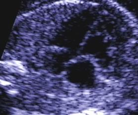 Atrial septum Foramen Ovale Located in middle one-third of atrial septum Flap is located in the left atrium Cardiac