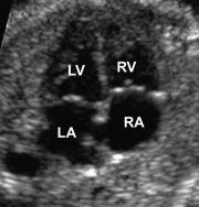 Sea-gull wing appearance (valves are normally off-set) Mitral valve has