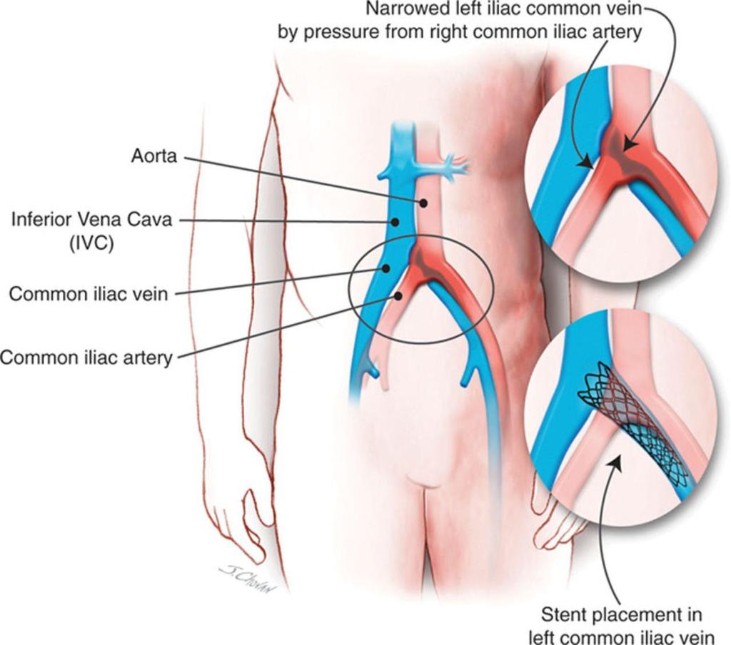 May-Thurner Syndrome From: Sarah Carroll, Stephan Moll Inferior Vena Cava Filters, May-Thurner