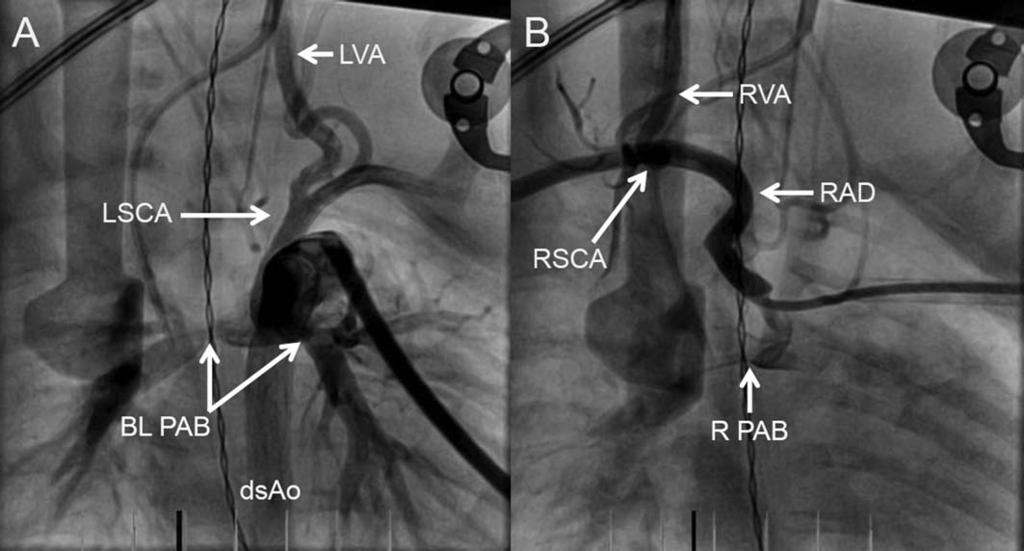 1158 Kobayashi et al. Fig. 1. Cardiac catheterization, pre-stent (antero-posterior view). A 7-Fr sheath is placed in the main pulmonary artery.