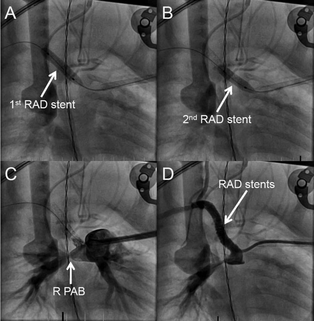 Bilateral Ductal Stenting 1159 Fig. 2. Stent placement on right ductus arteriosus (RAD) in antero-posterior view. A: First stent. A 0.