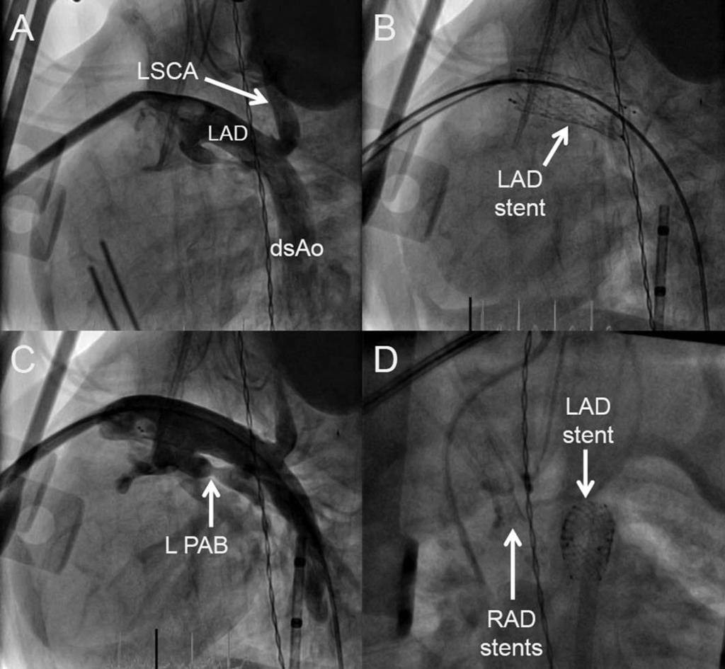 1160 Kobayashi et al. Fig. 3. Stent placement on left arterial duct (LAD) in lateral views (A C). A: Pre-stent angiography from the sheath in the main pulmonary artery.