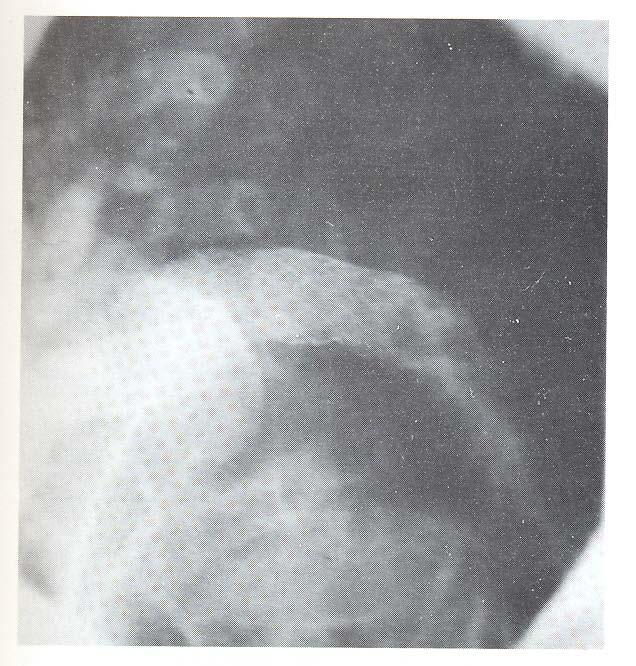 Seventeen stents were implanted at fifteen sites (Table 2). Figure 2. Right ventricular angiography after stenting of the left pulmonary artery.