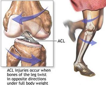ACL injury occurs when