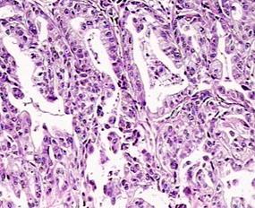 Cellular Heterogeneity in Gastric Cancer (GC) Intestinal Diffuse / Scirrhous