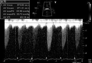 Peak and mean gradient SV at LVOT by continuity
