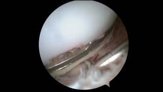 extended - If CR implant
