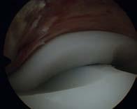 If flexion contracture persist Treatment of the final 10º of extension can still be unsuccessful.