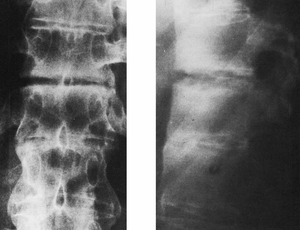 RDIOLOGIC VIGNETTE 4 89 Figure 5. Lower dorsal spine. 1972.. nteroposterior view.. Lateral projection.