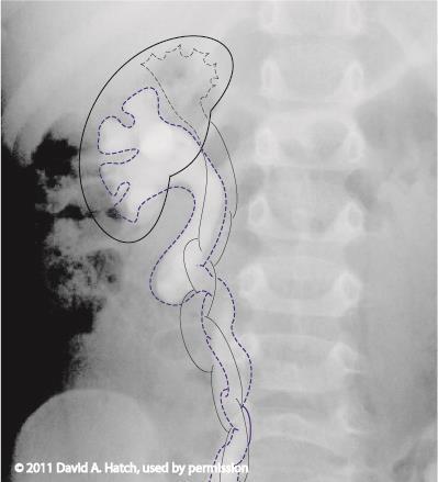 Abnormal Kidney Axis-Duplication This is a VCUG Duplication (two separate pelves and