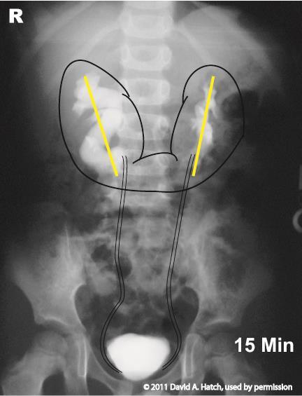 Abnormal Kidney Axis-Fusion This is an intravenous pyelogram. The x-ray was taken after i.v. contrast.