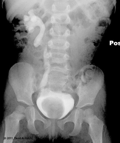 This is a Ureterocele Intravesical dilation of the distal ureter Remember, it is within the bladder Thought to result from a delayed rupture of