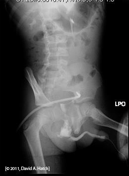 Film 1 Retrograde urethrogram (contrast injected into the urethra) Extravasation from urethral injury Contrast is seen in the kidney collecting system bilaterally because