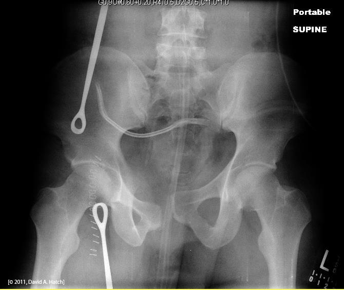 KUB Scout Film Bones? Pelvic fracture (see the separation of the symphysis pubis).