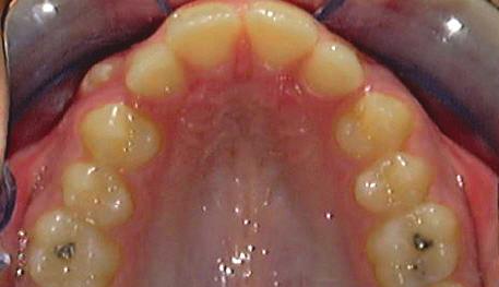 an effective way to achieve molar distalization when an increase in arch