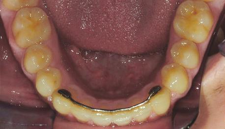 During retraction of the buccal segments we no longer have to struggle with