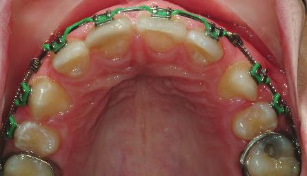 Pre-treatment with bilaterally blocked out maxillary cuspids 17 20D