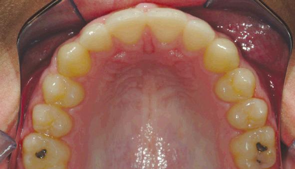 distalize the maxillary molars while maintaining mandibular incisor