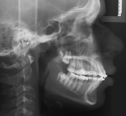 Figure 23: Progress after Forsus appliance removal space closure and establish molar occlusion.