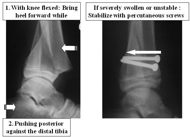 11 Figure 11 The steps in reducing the usual Supination-Plantar Flexion fractures.. 1. Apex anterior plastic deformation of the fibula. 2.