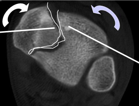 A horizontal CT cut through the epiphysis demonstrates the vertical fracture line in in the saggital plane.