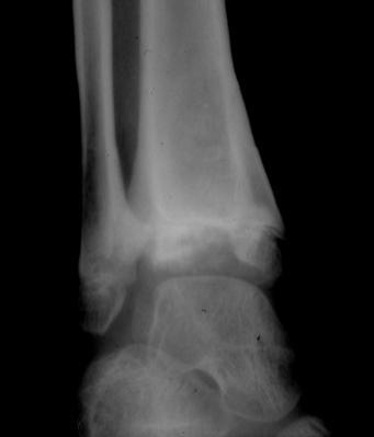 a A very comminuted fracture of the distal